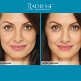 Radiesse
