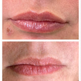 Hidratación de Labios con Skinbooster de Galderma