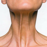 Nefertiti Lift con Toxina Botulínica (Dysport®)